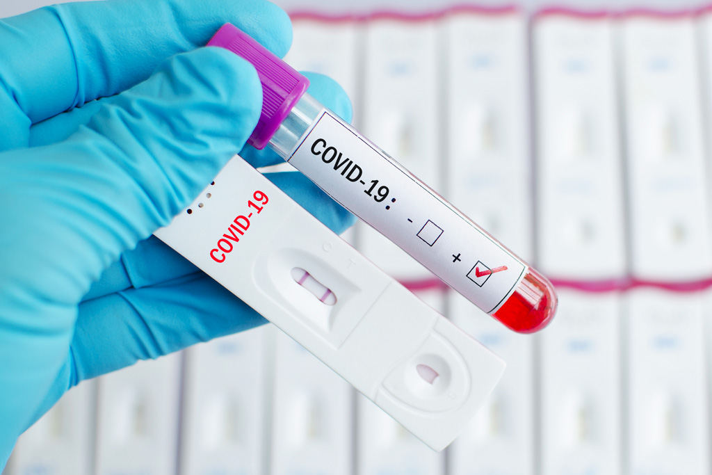Pannello anti SARS COV 2 (Covid19) IgG- IgM