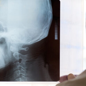 RX colonna cervicale